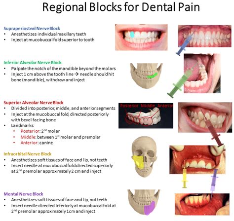 Regional Blocks For Dental Pain Management Dentalpain Grepmed
