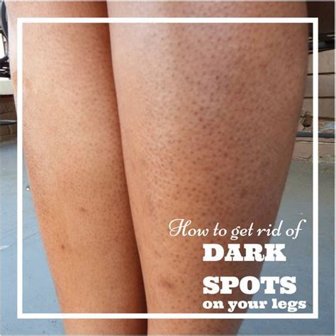How To Get Rid Of Dark Spots On Your Legs Aka Strawberry Legs Skin