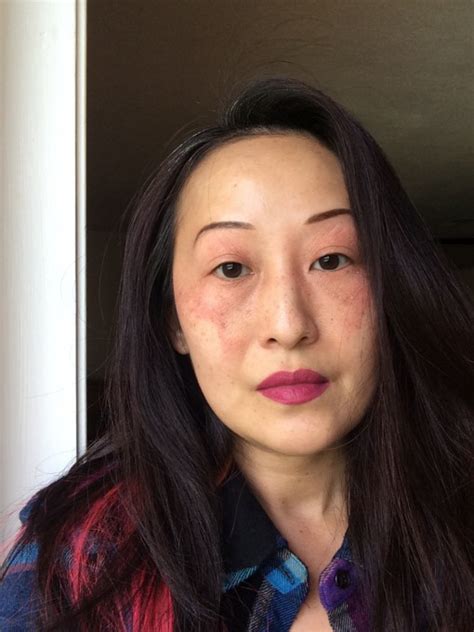 Skin Matters How I Healed My Face Post Angioedema Sheela Writes