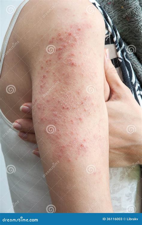 Allergic Rash Dermatitis Stock Image Image Of Infection 36116003
