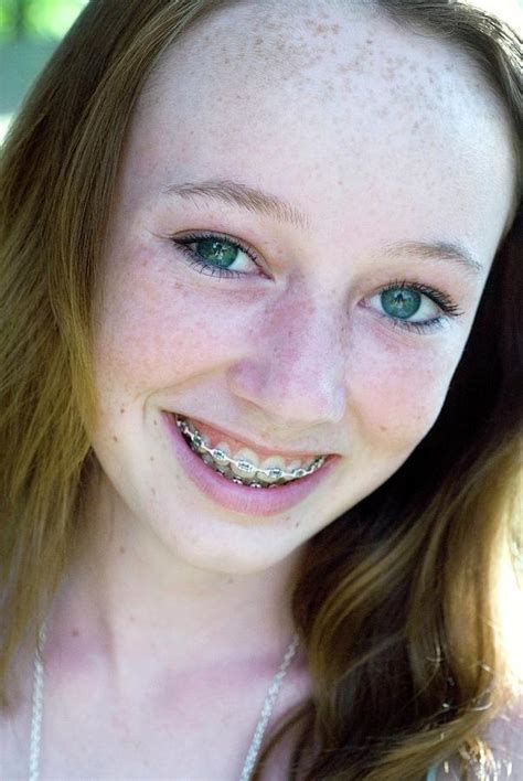 Teenager With Braces Photograph By Suzanne Grala Science Photo Library
