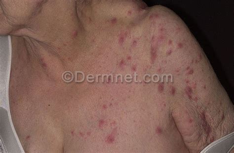 Scabies Photo Skin Disease Pictures