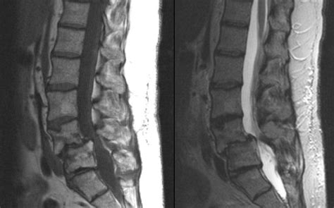 Lumbar Spinal Stenosis Spondylolithesis Sagitall
