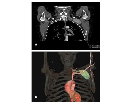A Ct Scan Findings Of Left Axillary Supraclavicular Lymph Node B