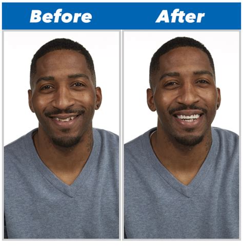 Perfect Smile Veneers™ | Perfect smile: removable veneer for the look of perfect teeth | Perfect ...