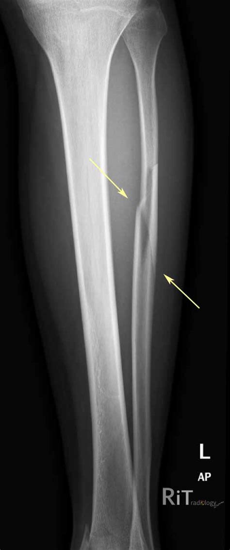 Fractured Fibula X Ray