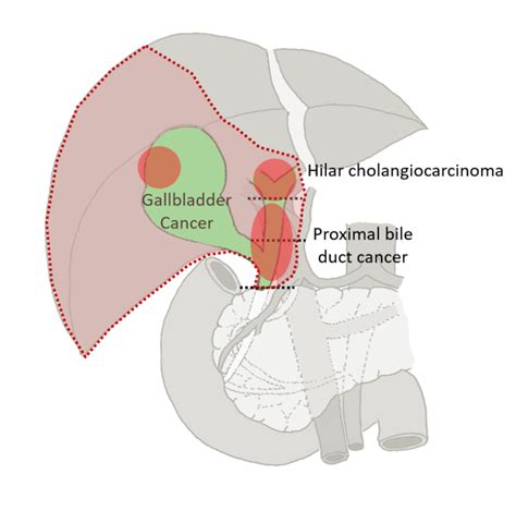 Treatment For Hilar Cholangiocarcinoma And Gallbladder Cancer Junichi