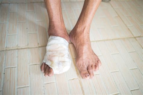 Healing Diabetic Foot Ulcers With Hbot