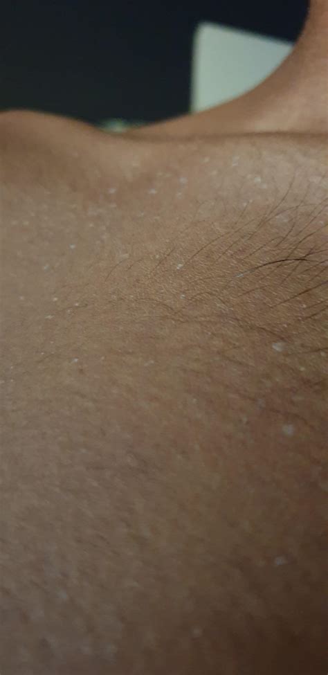 What Are These Little White Bumps All Over My Shoulder And Chest Area
