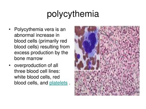 Rbc Count In Polycythemia Vera 10 High Red Blood Cell Count