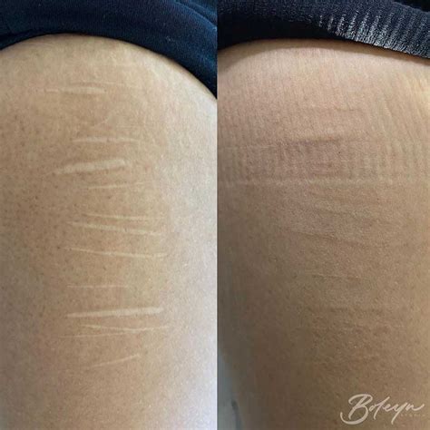 Stretch Marks Tattoo Basic Info Risks Cost And Downsides