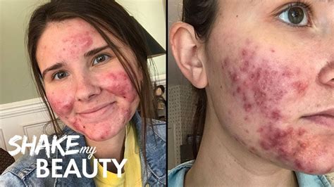 Worst Makeup For Acne E Skin Mugeek Vidalondon