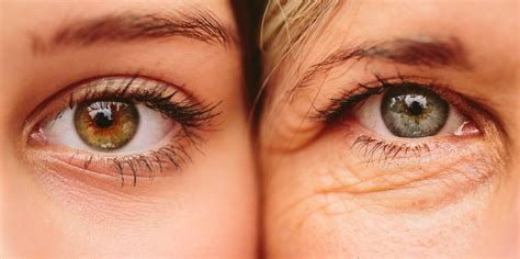 Treat Under Eye Wrinkles Skinesse Clinic Gerrards Cross Uk