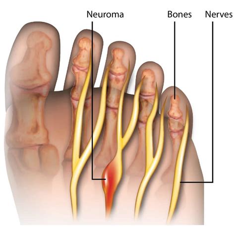 Mortons Neuroma Causes Symptoms Diagnosis Treatment