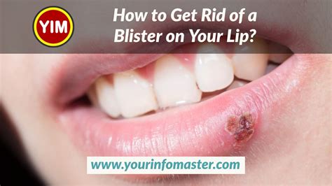 How To Get Rid Of A Blister On Your Lip Your Info Master