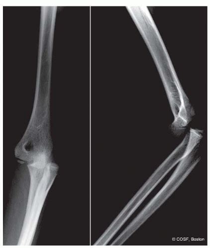 Medial Epicondyle Fractures And Elbow Dislocations Musculoskeletal Key