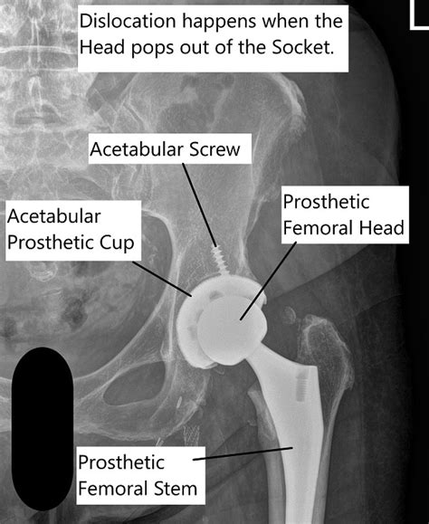 Dislocation Following Total Hip Replacement Causes And Cures Raymundoroegner 99