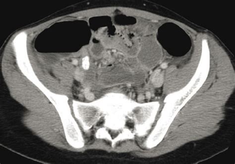 An 18 Year Old Female With Right Lower Quadrant Pain Ct Scan With Oral