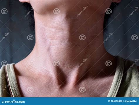 Smooth Diffuse Thyroid Swelling Of Southeast Asian Myanmar Or Burmese