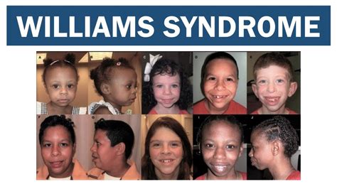 Williams Syndrome Youtube