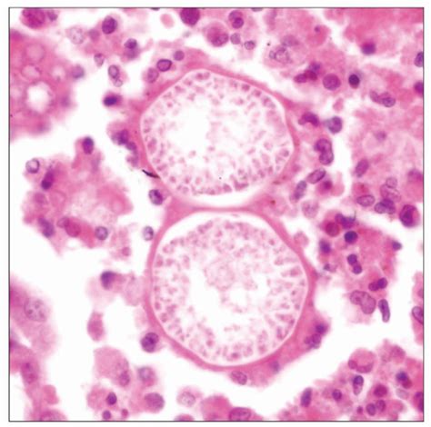 Coccidioidomycosis Basicmedical Key