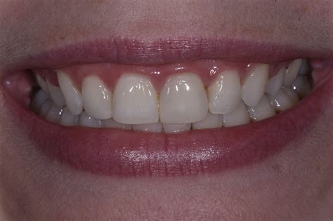 Composite Veneers | Pre-Prosthetic Orthodontics | Responsible Esthetics