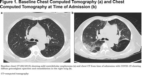 Ct Features Of Covid 19 Emphysema Patients Journal Of The Copd Foundation