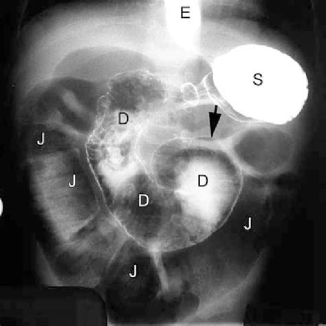 A B Plain Films Of The Abdomen Supine A And Upright B Abdominal