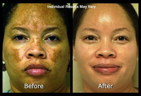 Hyperpigmentation Scottsdale Skin Spot And Discoloration Treatments