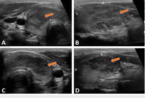 Thyroid Ultrasound Us Showing Heterogeneous Diffuse Goiter Without