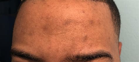 Routine Help Someone Made A Comment About These Spots On My Forehead