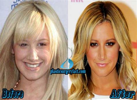 Ashley Tisdale Nose Job Before And After Plastic Surgery Facts