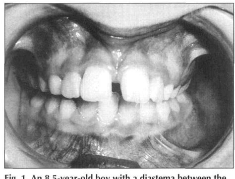 Figure 1 From The Midline Diastema A Review Of Its Etiology And
