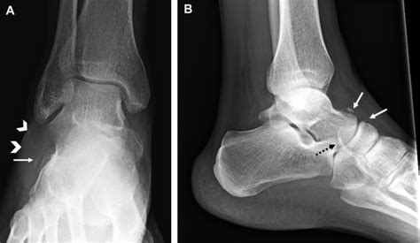 Anteroposterior Radiograph Of The Ankle With Cross Sectional Imaging
