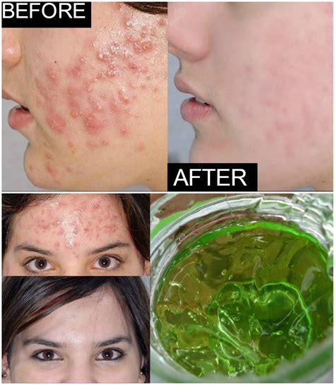 4 Effective Home Remedies To Get Rid Of Acne And Pimples My Simple Remedies