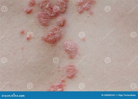 Eczema Groin Atopic Dermatitis Symptom Of Skin Texture Stock Photo Images