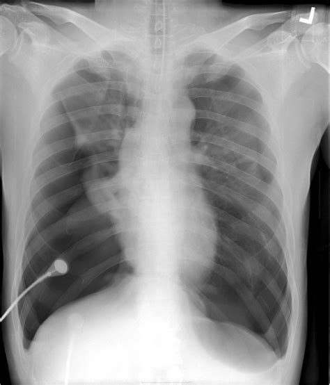 Chest X Ray Showing Bilateral Pneumothorax With A Flattened Diaphragm Sexiz Pix