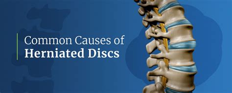 What Causes A Herniated Disc Spine Ina New Jersey