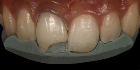 Anterior Composite Restorations Ora Clínica Medicina Dentária