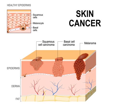 What To Watch Out For Early Signs Of Skin Cancer