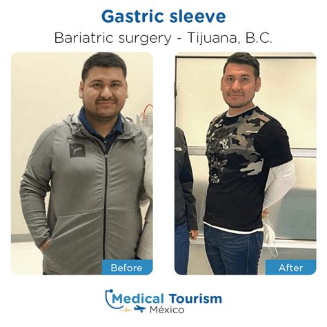 Reviews For Bariatric Surgery In Tijuana Medical Tourism Mexico