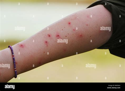 Arm Covered In Mosquito Bites Samboja East Kalimantan Kalimantan