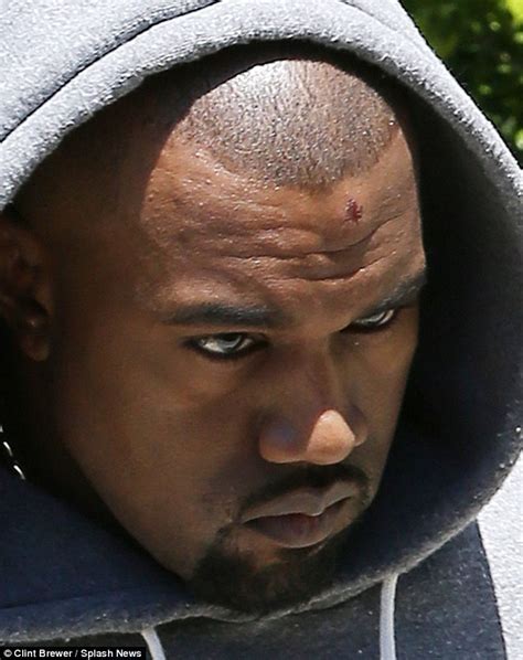 Grumpy Kanye West Sports Ghastly Bump On His Head One Day After