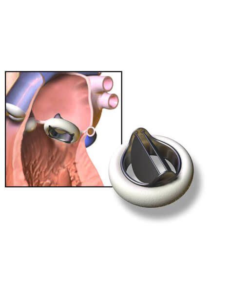 Learn How Heart Valve Replacement Works Valiant Clinic