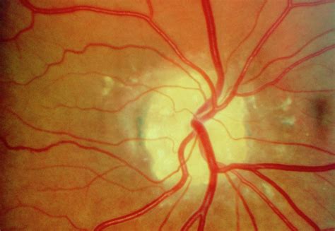 Ophthalmoscopy Of Retina Showing Optic Disc Drusen Photograph By Paul