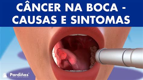 C Ncer De Boca Causas Sintomas E Tipos De Tumores Na Boca Youtube