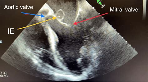 Aortic Mitral Curtain