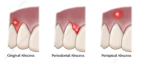 Types Of Dental Abscesses Illustration Stock Image C0366294