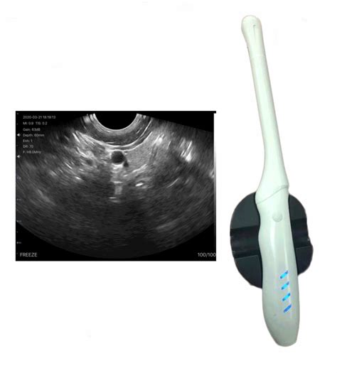 Wireless Transvaginal Ultrasound Vsono Tvu2 Vendra Medical