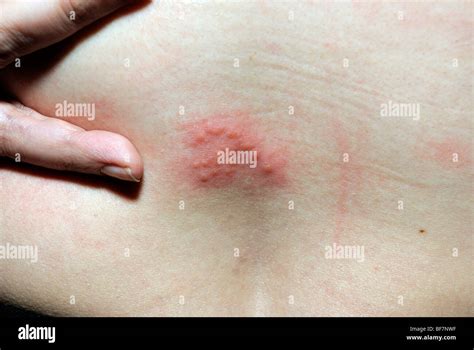 Shingles Rash Pictures Sexy Fucking Images
